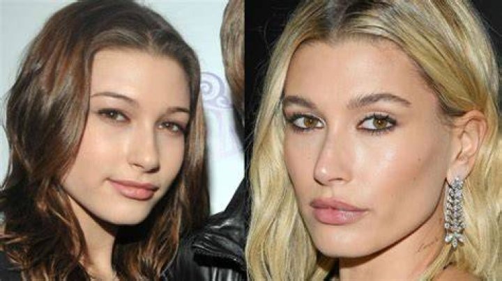Hailey Bieber had procedure to fix a hole in her heart after stroke